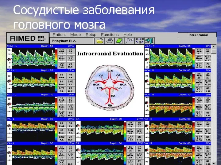 Cосудистые заболевания головного мозга