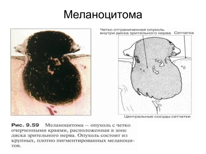 Меланоцитома