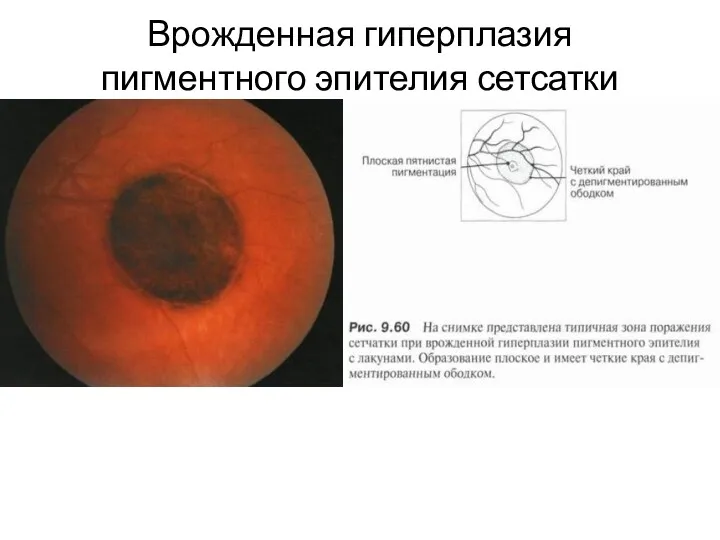 Врожденная гиперплазия пигментного эпителия сетсатки