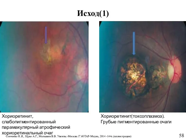 Исход(1) Хориоретинит, слабопигментированный парамакулярный атрофический хориоретинальный очаг Хориоретинит(токсоплазмоз). Грубые пигментированные
