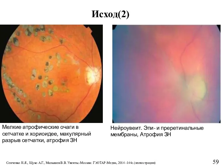 Исход(2) Мелкие атрофические очаги в сетчатке и хориоидее, макулярный разрыв