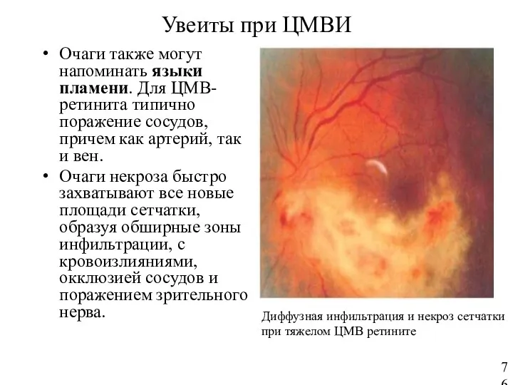 Увеиты при ЦМВИ Очаги также могут напоминать языки пламени. Для