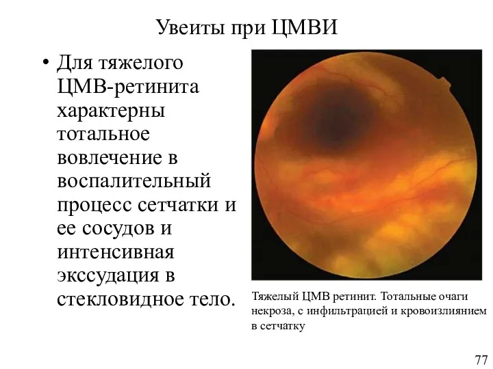 Увеиты при ЦМВИ Для тяжелого ЦМВ-ретинита характерны тотальное вовлечение в