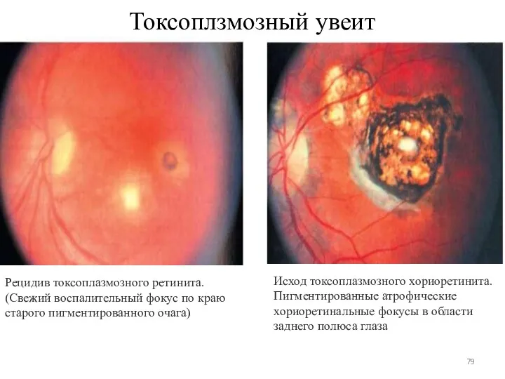 Токсоплзмозный увеит Исход токсоплазмозного хориоретинита. Пигментированные атрофические хориоретинальные фокусы в