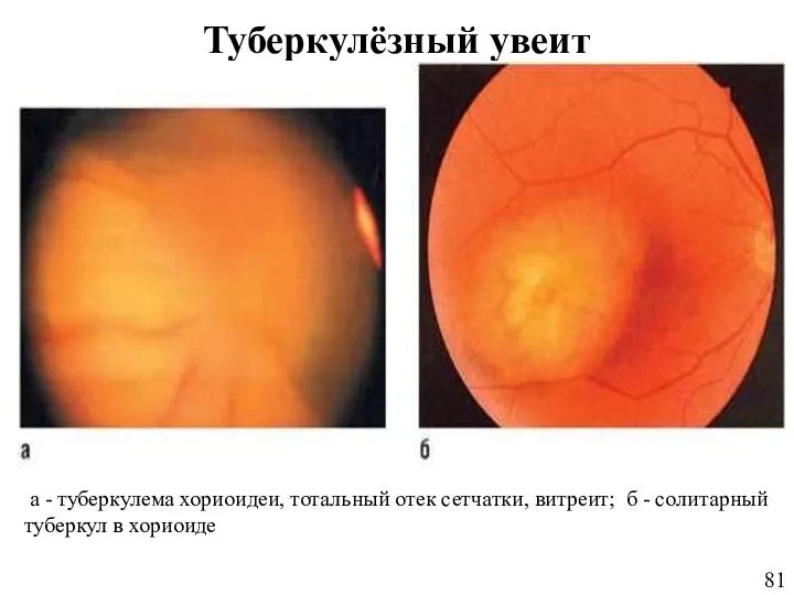 Туберкулёзный увеит а - туберкулема хориоидеи, тотальный отек сетчатки, витреит; б - солитарный туберкул в хориоиде