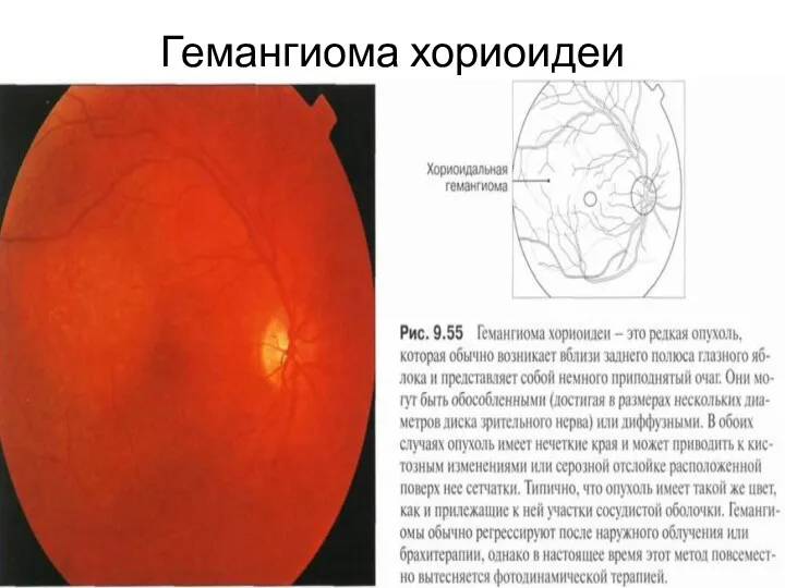 Гемангиома хориоидеи