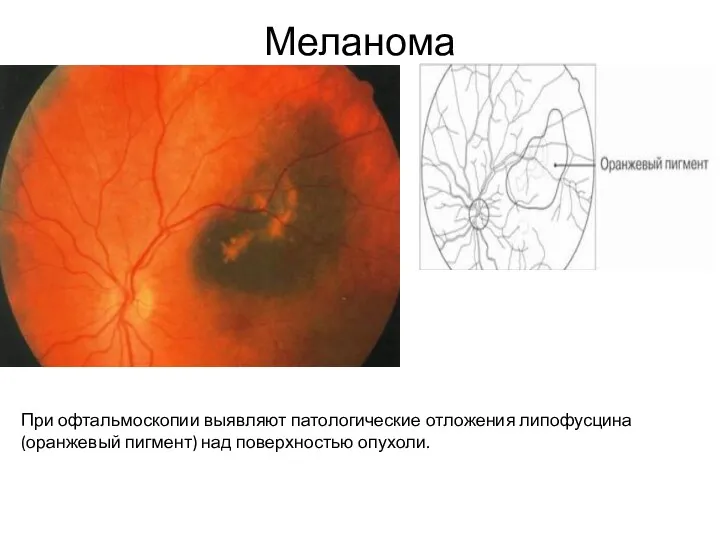 Меланома При офтальмоскопии выявляют патологические отложения липофусцина(оранжевый пигмент) над поверхностью опухоли.