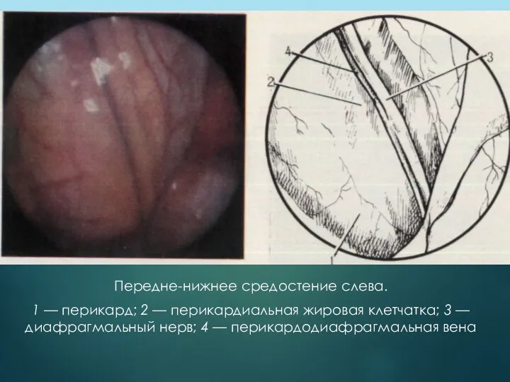 Передне-нижнее средостение слева. 1 — перикард; 2 — перикардиальная жировая