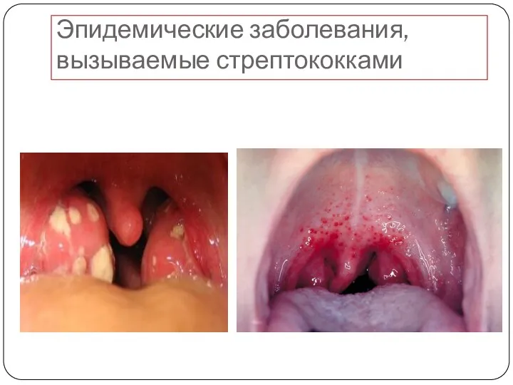 Эпидемические заболевания, вызываемые стрептококками