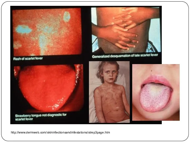 http://www.dermweb.com/skininfectionsandinfestations/strep3page.htm