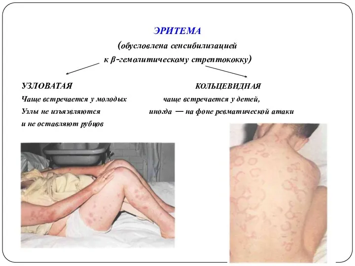 ЭРИТЕМА (обусловлена сенсибилизацией к β-гемолитическому стрептококку) УЗЛОВАТАЯ КОЛЬЦЕВИДНАЯ Чаще встречается