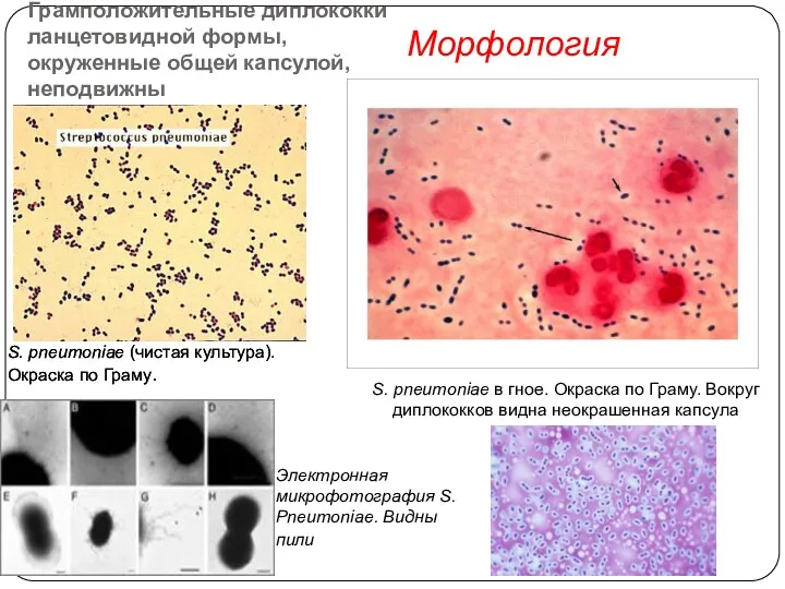 Морфология S. pneumoniae в гное. Окраска по Граму. Вокруг диплококков