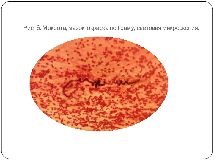 Рис. 6. Мокрота, мазок, окраска по Граму, световая микроскопия.