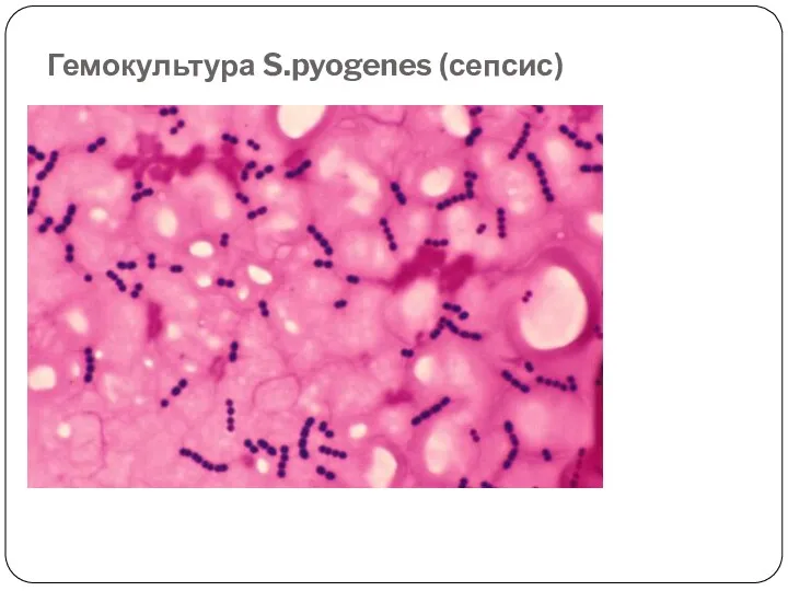 Гемокультура S.pyogenes (сепсис)