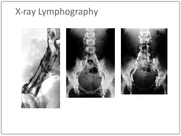 X-ray Lymphography
