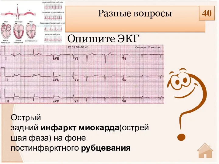 Острый задний инфаркт миокарда(острейшая фаза) на фоне постинфарктного рубцевания Опишите ЭКГ Разные вопросы 40