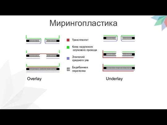 Мирингопластика Overlay Underlay Трансплантат Кожа наружного слухового прохода Эпителий среднего уха Барабанная перепонка