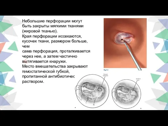 Небольшие перфорации могут быть закрыты мягкими тканями (жировой тканью). Края