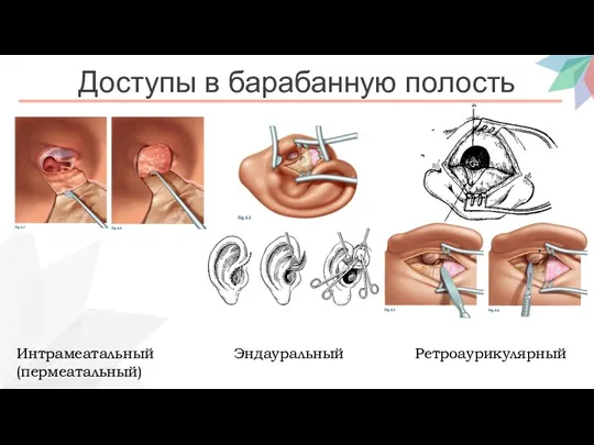 Доступы в барабанную полость Интрамеатальный (пермеатальный) Ретроаурикулярный Эндауральный