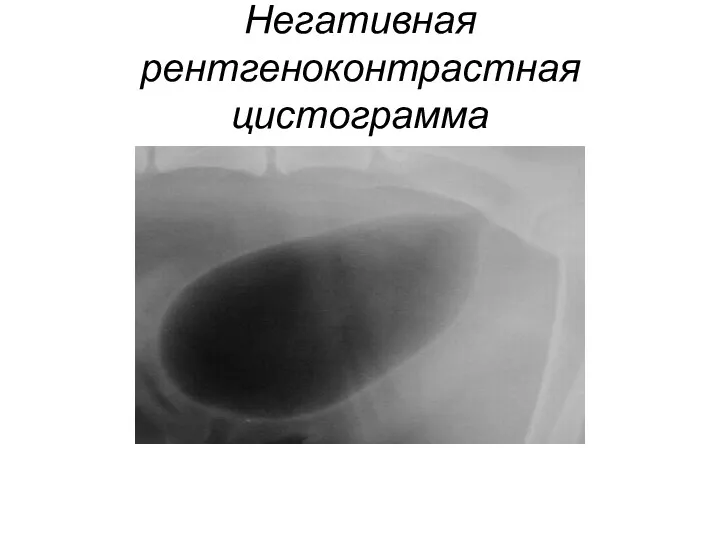 Негативная рентгеноконтрастная цистограмма