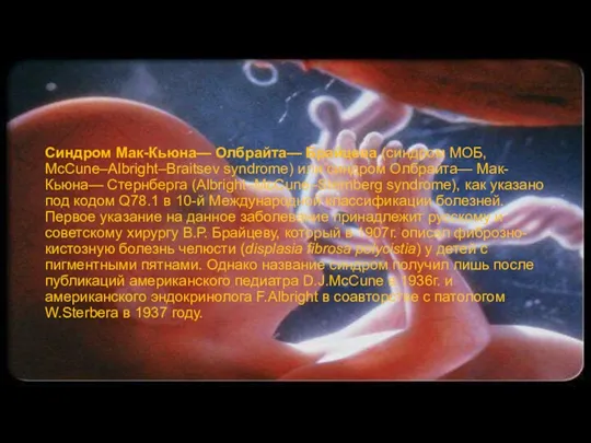 Синдром Мак-Кьюна— Олбрайта— Брайцева (синдром МОБ, McCune–Albright–Braitsev syndrome) или синдром