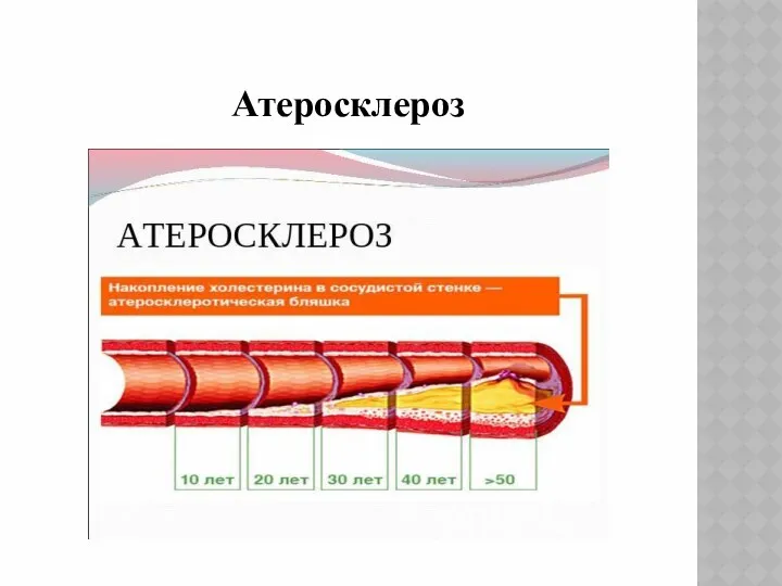 Атеросклероз