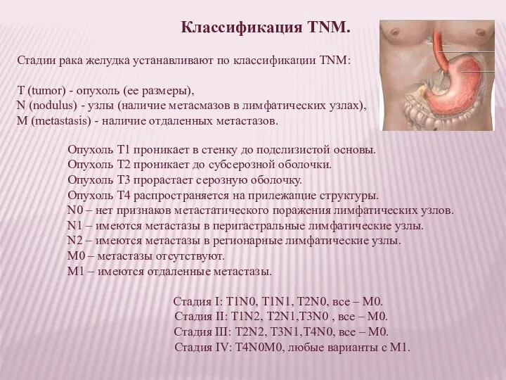 Классификация TNM. Стадии рака желудка устанавливают по классификации TNM: T