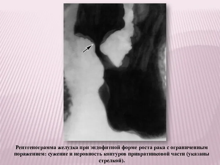 Рентгенограмма желудка при эндофитной форме роста рака с ограниченным поражением: