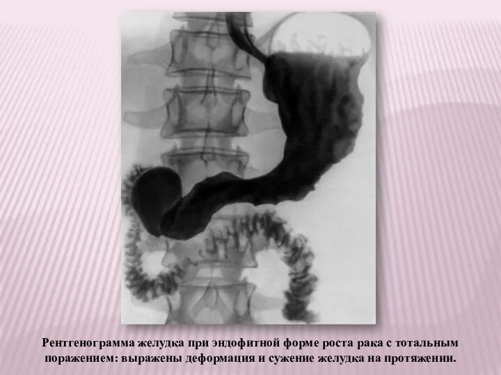 Рентгенограмма желудка при эндофитной форме роста рака с тотальным поражением: