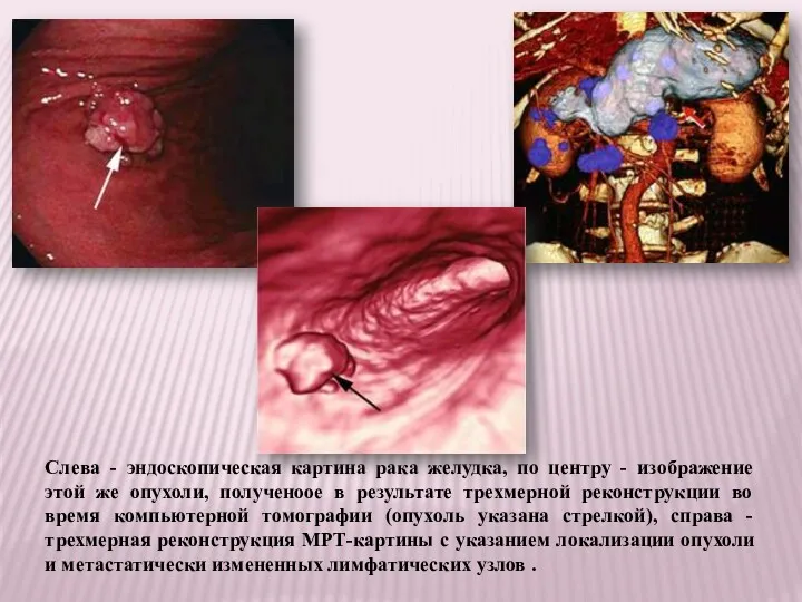 Слева - эндоскопическая картина рака желудка, по центру - изображение