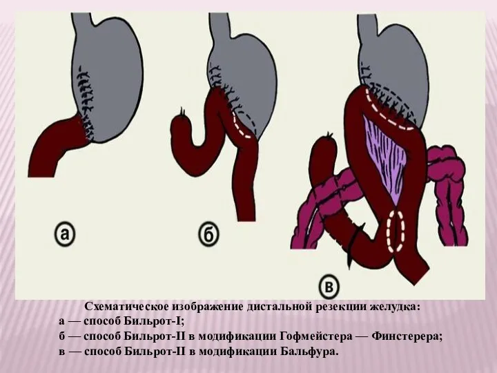 Схематическое изображение дистальной резекции желудка: а — способ Бильрот-I; б