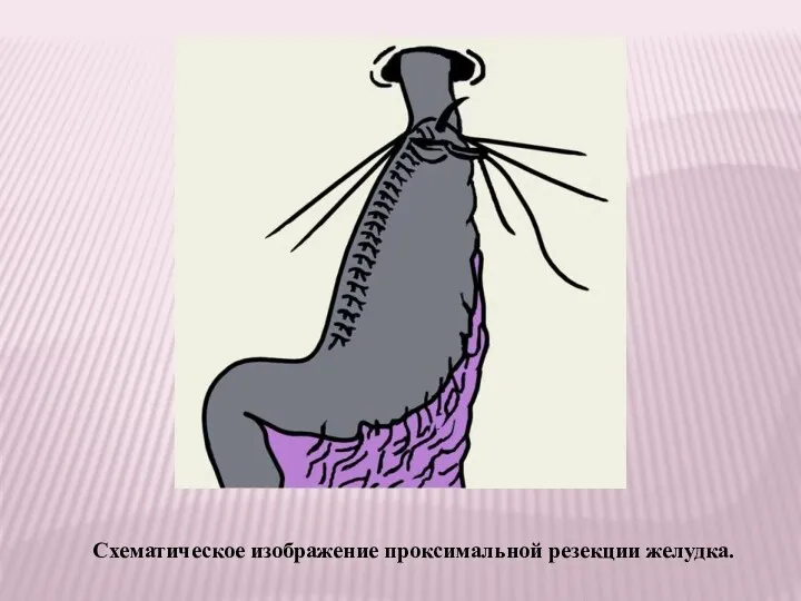 Схематическое изображение проксимальной резекции желудка.
