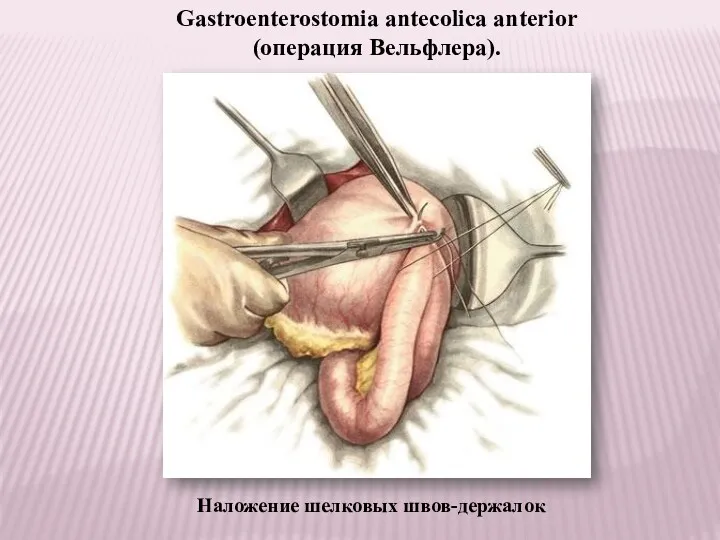 Наложение шелковых швов-держалок Gastroenterostomia antecolica anterior (операция Вельфлера).