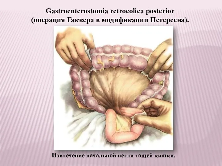 Извлечение начальной петли тощей кишки. Gastroenterostomia retrocolica posterior (операция Гаккера в модификации Петерсена).