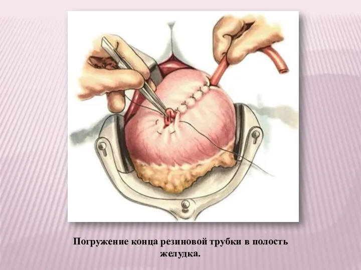 Погружение конца резиновой трубки в полость желудка.