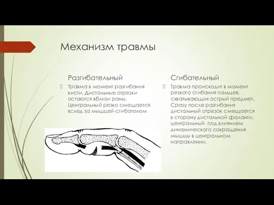 Механизм травмы Разгибательный Травма в момент разгибания кисти. Дистальные отрезки