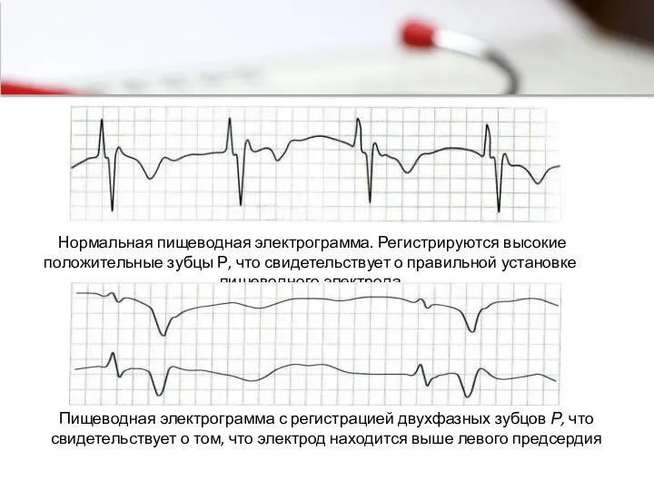 Нормальная пищеводная электрограмма. Регистрируются высокие положительные зубцы Р, что свидетельствует