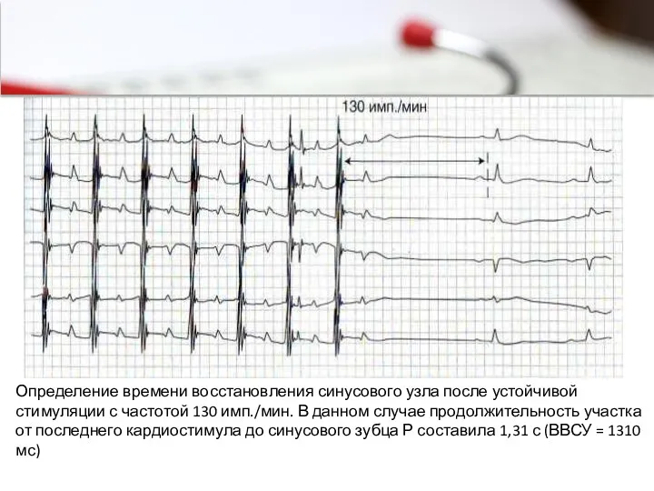 Определение времени восстановления синусового узла после устойчивой стимуляции с частотой