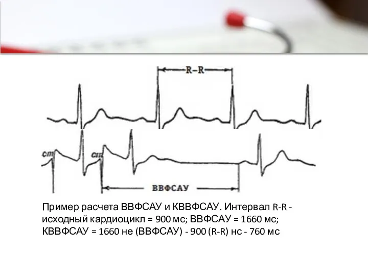 Пример расчета ВВФСАУ и КВВФСАУ. Интервал R-R - исходный кардиоцикл