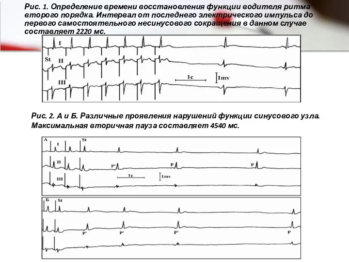 Рис. 1. Определение времени восстановления функции водителя ритма второго порядка.