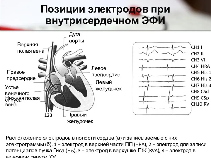 Позиции электродов при внутрисердечном ЭФИ 123 Дуга аорты Правое предсердие