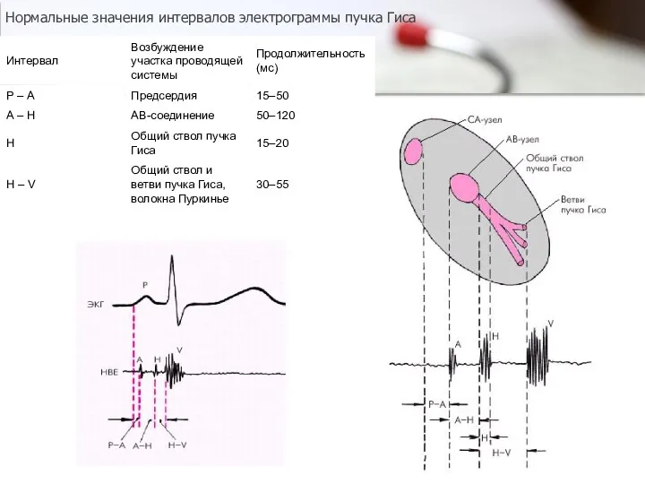 Нормальные значения интервалов электрограммы пучка Гиса