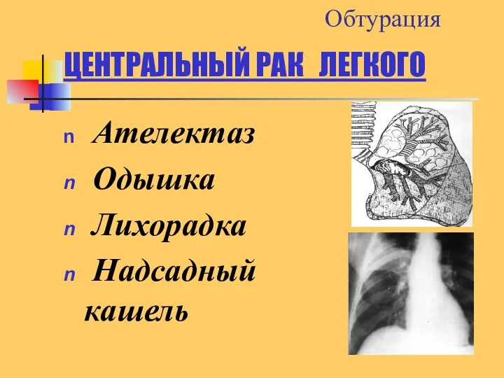 ЦЕНТРАЛЬНЫЙ РАК ЛЕГКОГО Ателектаз Одышка Лихорадка Надсадный кашель Обтурация