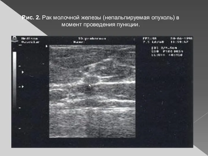 Рис. 2. Рак молочной железы (непальпируемая опухоль) в момент проведения пункции.