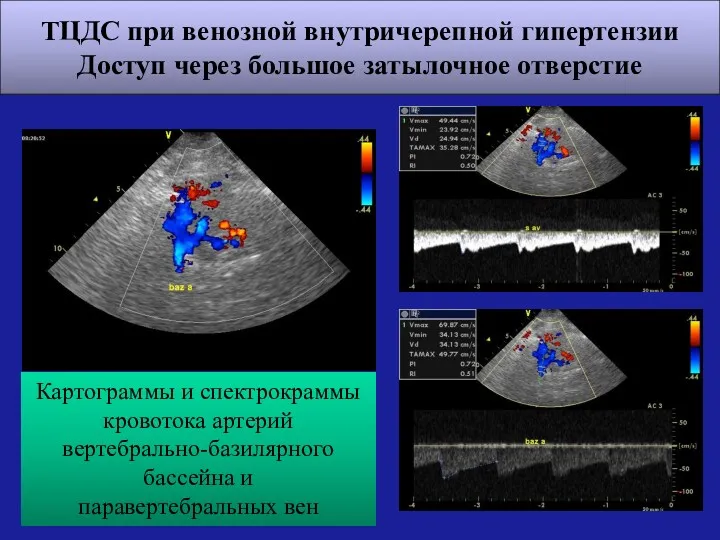 ТЦДС при венозной внутричерепной гипертензии Доступ через большое затылочное отверстие