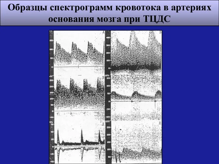 Образцы спектрограмм кровотока в артериях основания мозга при ТЦДС