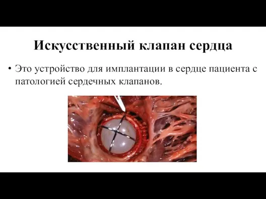 Искусственный клапан сердца Это устройство для имплантации в сердце пациента с патологией сердечных клапанов.