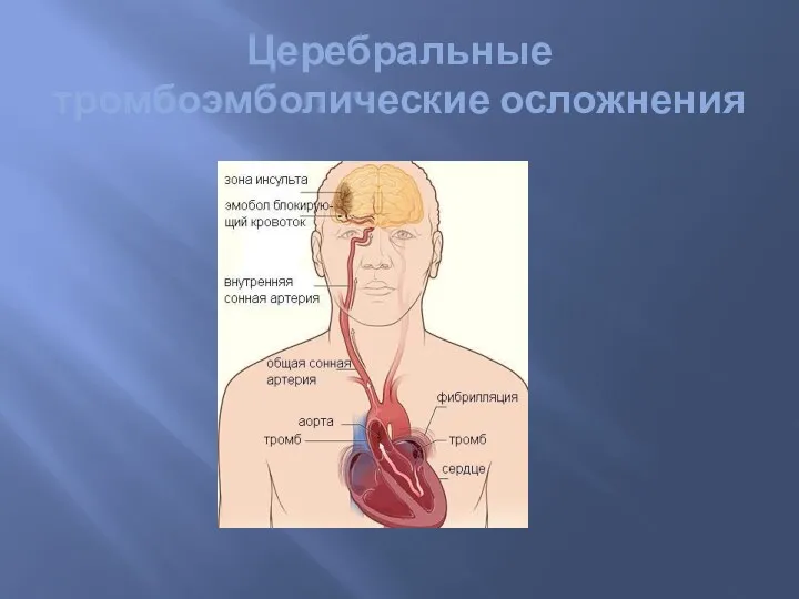 Церебральные тромбоэмболические осложнения