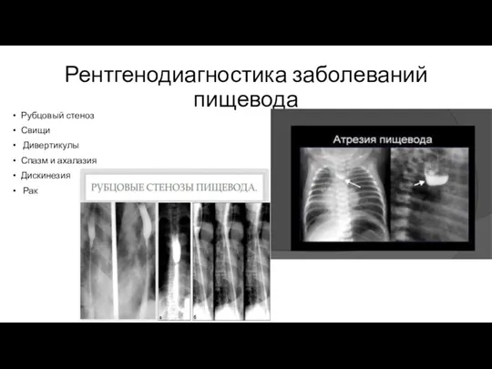 Рентгенодиагностика заболеваний пищевода Рубцовый стеноз Свищи Дивертикулы Спазм и ахалазия Дискинезия Рак