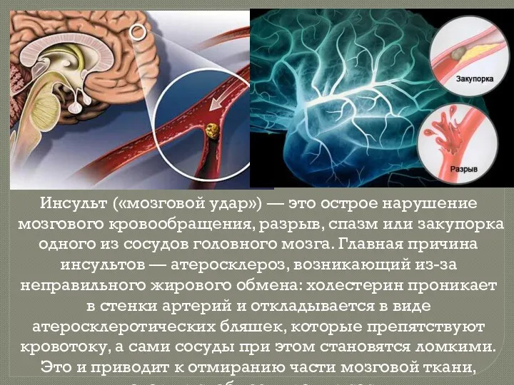 Инсульт («мозговой удар») — это острое нарушение мозгового кровообращения, разрыв, спазм или закупорка